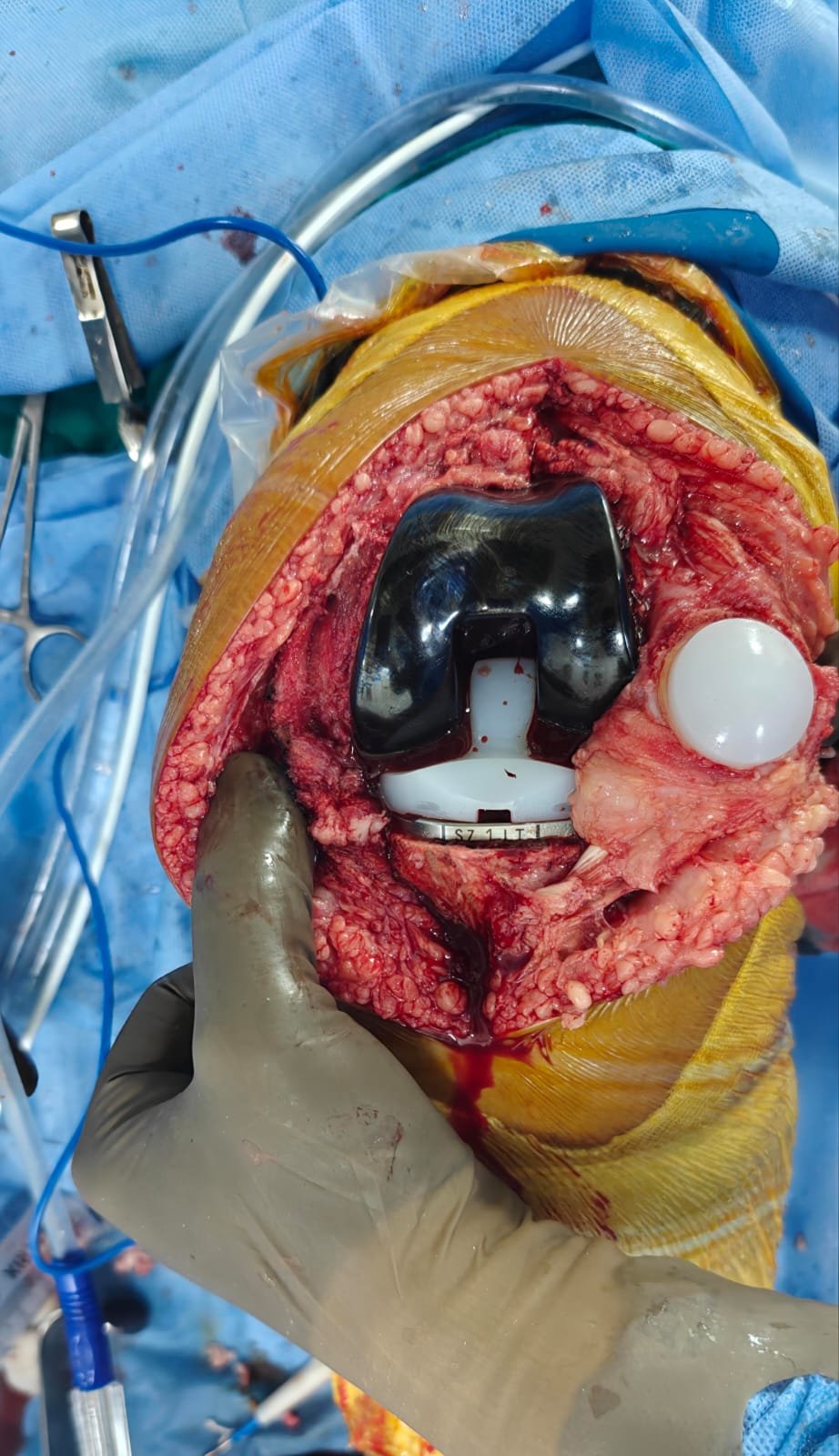 Surgical Procedure