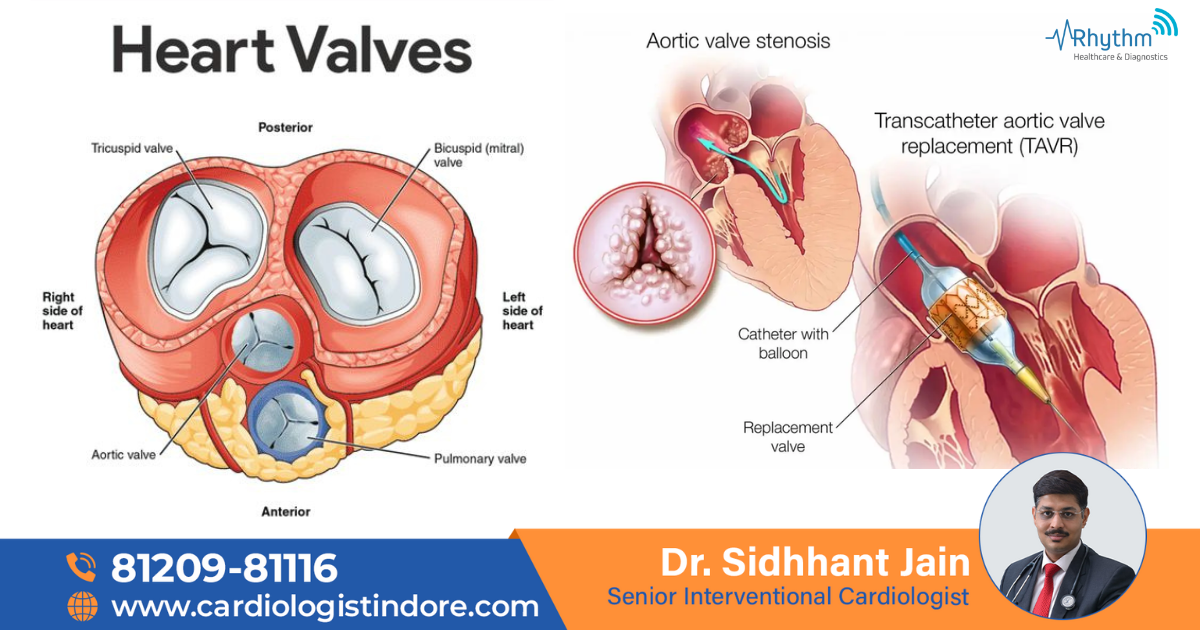 What is the TAVI Process - cardiologist indore